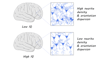 A low IQ refers to an individual who has an IQ score of 70 and below. A low IQ score person has an intellectual disability with specific signs such as a lack of learning or thinking abilities.